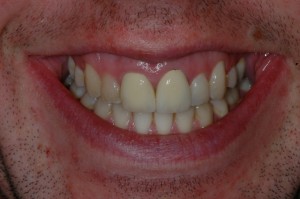 Tooth Teeth Whitening