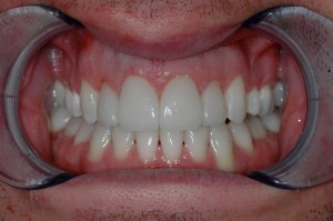 Completed Tooth Teeth Whitening