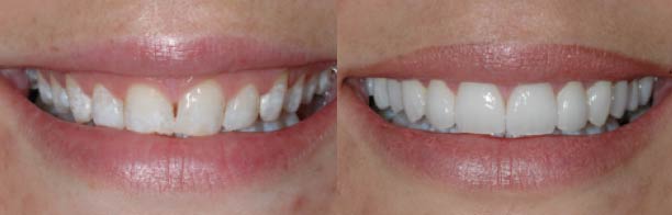 Consider Laser recontouring to reduce gumminess and improve gum symmetry.