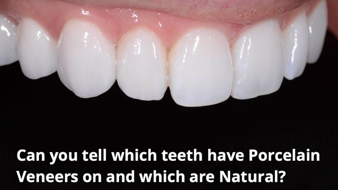Perth Cosmetic Dentist Explains The Things You Should Know To Help You Decide If Porcelain Veneers Are For You