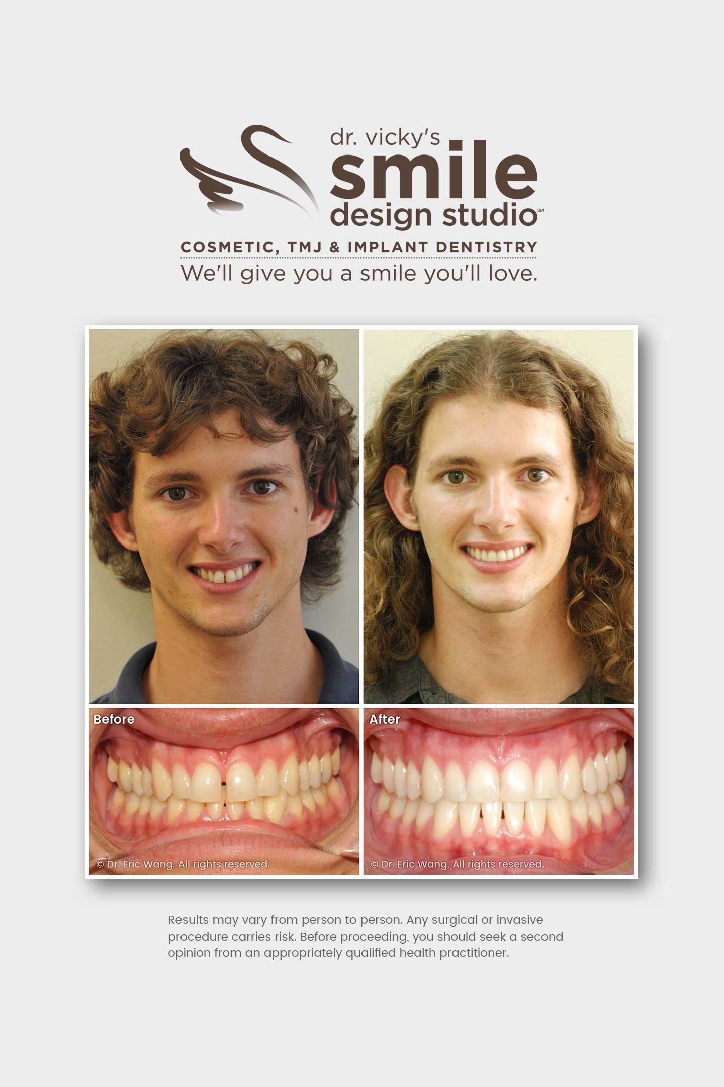 Damon Clear & Teeth Whitening