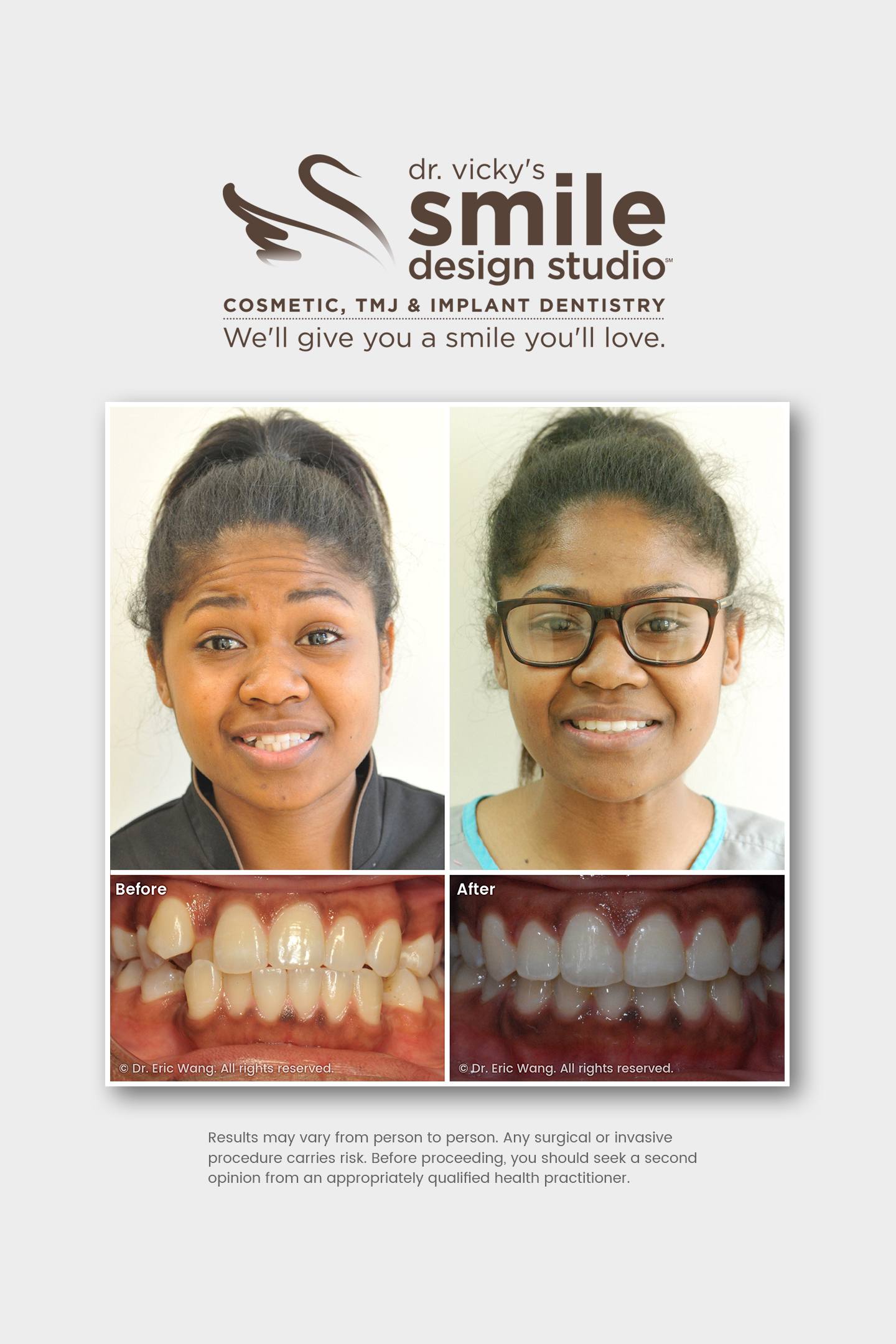 Damon Clear Braces (with extractions)