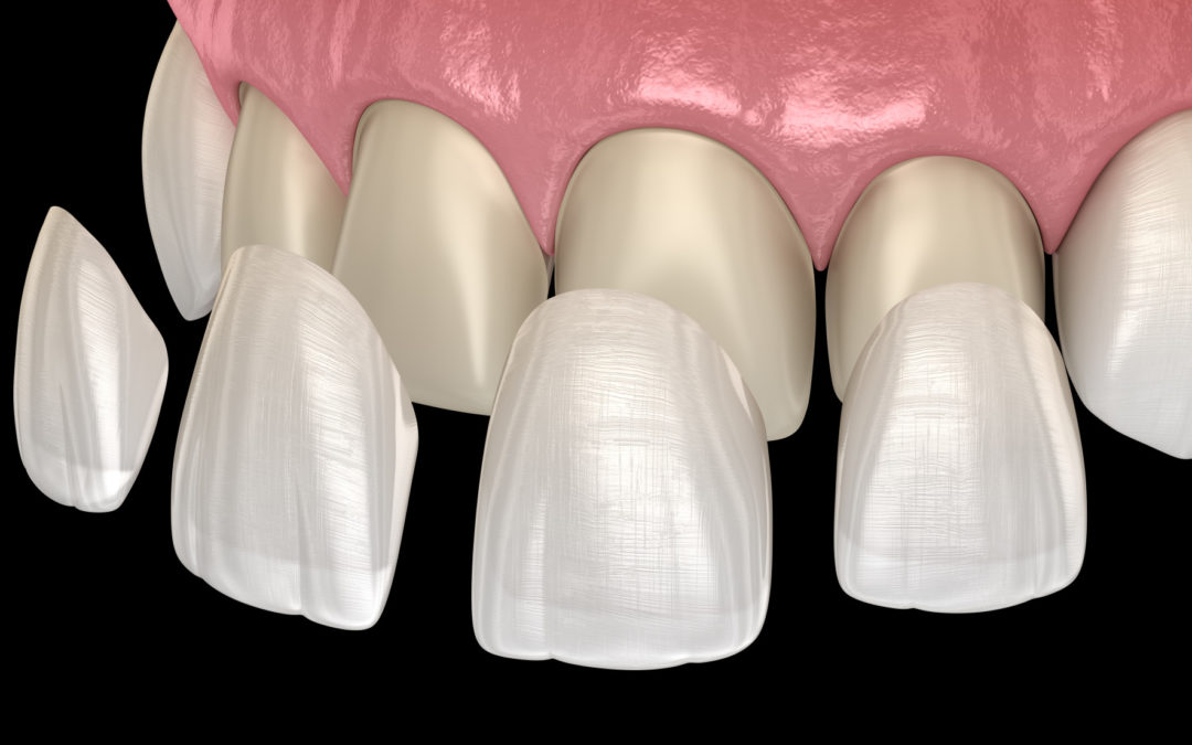 How Much are Veneers? What You Need to Know
