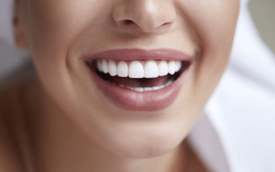How Much Do Cosmetic Veneers Cost?
